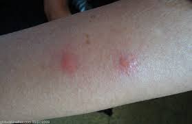 Image result for Papular urticaria