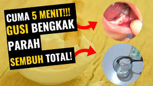 We did not find results for: 5 Menit Cara Mengobati Gusi Bengkak Karena Gigi Berlubang Dan Di Dalam Gigi Berlubang Dengan Cepat Youtube