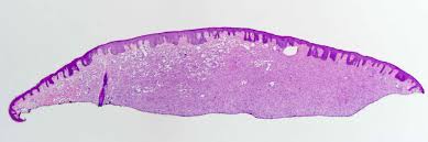 Image result for Dermatofibrosarcoma Protuberans