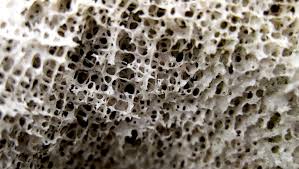 Bernoulli's beam theory, describe the amount and distribution of. Osteoporosis Risk Predicted With Genetic Test Scope