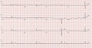 Maybe you would like to learn more about one of these? Electrocardiogram On Admission Revealed A Third Degree Atrioventricular Download Scientific Diagram