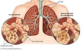 Because of the degree of lung damage at this stage, you are at high risk for lung infections and respiratory failure. Chronic Obstructive Pulmonary Disease Pathology Britannica