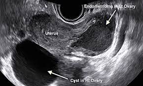 Endometriosis from endometriosis.org on vimeo. Types Symptoms Of Ovarian Cysts Dr Anthony Siow