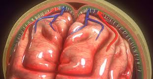 Image result for Hydrocephalus