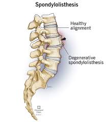 Image result for Lumbar vertebrae