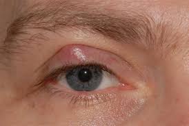Image result for milium cyst on eyelid