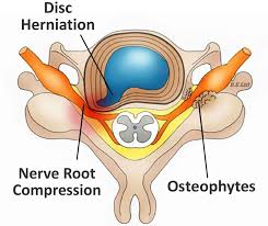 Cervical Disc Herniation Cervical Radiculopathy Cervical Disc Disk Herniation