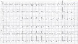 Symptoms of myocarditis include chest pain, shortness of breath, fatigue, and fluid accumulation in the lungs. Emconf Ecg Em Daily
