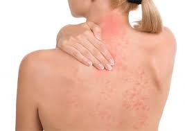 Entretanto, muitos estudos dizem que ela está. Psoriase Dermatologista Alerta Para Tratamento Da Doenca Folha Pe