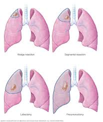 But in some cases, they may occur before that and actually be what tips you off that something is wrong. Lung Cancer Diagnosis And Treatment Mayo Clinic