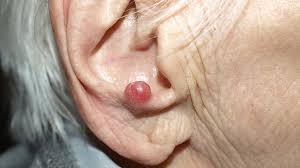 We may earn commission from links on this page, but we only recommend products we back. Merkel Cell Carcinoma Causes Symptoms And Treatment