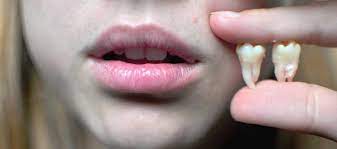 Other tips to aid in recovery: Wisdom Teeth Removal Facts You Need To Know About Extraction And Recovery Rozenberg Dental Nyc General Dentists