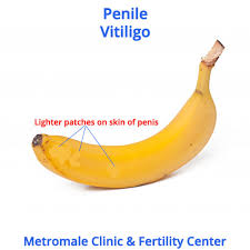 Image result for penis mycosis symptoms