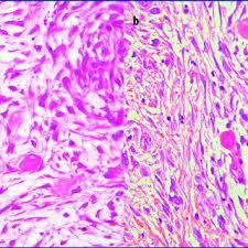 (10) symptoms of peritoneal mesothelioma. Pdf Sclerosing Peritoneal Mesothelioma In A Dog Histopathological Histochemical And Immunohistochemical Investigations