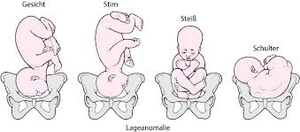 Nach etwa dem ersten lebensjahr kann ihr baby dann auf dem bauch schlafen. Ungewohnliche Lage Und Haltung Des Kindes Bei Der Geburt Gesundheitsprobleme Von Frauen Msd Manual Ausgabe Fur Patienten