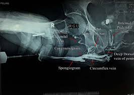 Image result for Retrograde Urethrogram