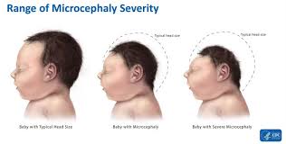 See your doctor or other healthcare provider. Zika Virus Highlights Flaws In Public Health Approaches In The Americas Part 1 Impakter