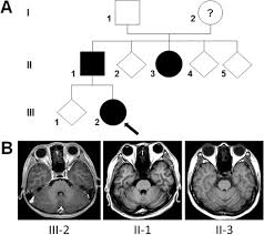 Spastic Paraparesis As The First Manifestation Of Machado Joseph Disease A Case Report And Review Of The Literature Sciencedirect
