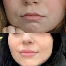 Don't cancel me but…… I can't stand lip fillers. I'm telling yall now. It  doesn't look how yall think it looks.