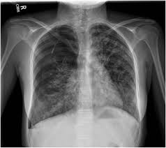 Typical pleural effusion typical pleural effusion. Pleural Effusions And Pneumothoraces American Academy Of Pediatrics