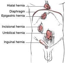 Surgery involves an open hernia repair and. Strengthen Weak Icd 10 Hernia Coding Aapc Knowledge Center