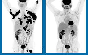 That doesn't mean your cancer is gone forever. Terminal Cancer Patients In Complete Remission After One Gene Therapy Treatment