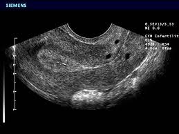 Flashcards Ob Gyn Sonography Obstetric Gynecology Studyblue Sonography Transvaginal Ultrasound Ultrasound Sonography