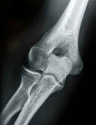X rays tend to cost between $100 and $1000 depending on the area of the body that is being examined. Elbow X Ray