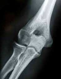 Pain is felt over the lateral epicondyle and radiates down forearm. Elbow X Ray