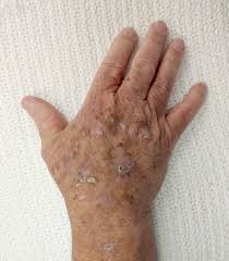 Melanoma is a potentially fatal disease that is largely preventable. Actinic Keratosis Wikipedia
