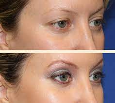 I have excess skin that crinkles on the sides of my eyelids. Traditional Eyelid Lift Before And After 08