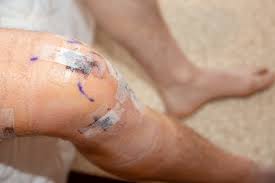 Image result for Skin Tear