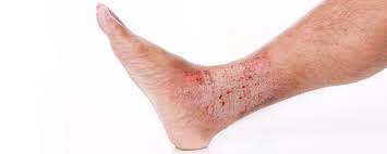 Image result for Lichen Simplex Chronicus