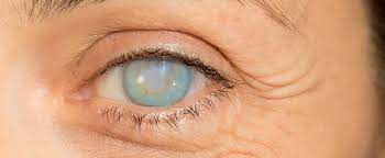 Explore more like what blindness looks like. Corneal Blindness Treatment In Delhi Causes Prevention Cure