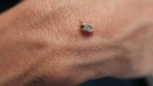 Image result for Tick Paralysis