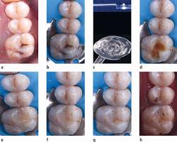 Image result for Occlusal