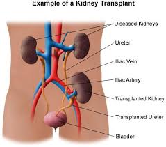 Kidney Transplant Criteria For Donor As Well As Recipient Kidney Transplant Kidney Dialysis Renal Transplant