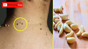 Tindakan medis ini hanya boleh dilakukan oleh. Cara Menghilangkan Daging Tumbuh Di Leher Dengan Mudah Cepat Youtube