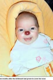 Menina nasce com nariz vermelho e passa por cirurgia de três horas para  corrigir o problema