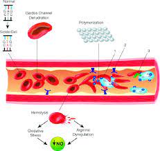 In sickle cell anemia, the red blood cells become rigid and shaped like crescents, or sickles, rather than being flexible and round. Schematic Representation Of The Pathophysiology In Part Of Sickle Download Scientific Diagram