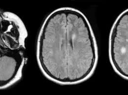 A ressonância magnética é altamente eficiente para diagnosticar esclerose múltipla, tumores no cérebro e na glândula pituitária, infecções no cérebro e nas articulações, infecções na medula espinhal, lesões nos ombros, tendinite, derrame em estágio inicial, ligamentos rompidos no pulso, joelho e tornozelo. Novos Criterios De Diagnostico Para Esclerose Multipla Em