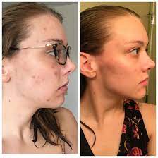 Supports immune function, strengthens collagen for healthy skin, & provides antioxidants* Six Weeks Progress Of No Picking And Vitamin C Serum To Help With My Scarring Thanks To R Skincareaddiction For The Product Recommendation Compulsiveskinpicking