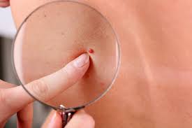 It may be that you just started noticing them. Cherry Angioma What Do Red Moles Mean And Are They Dangerous