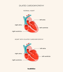 Image result for Cardiomyopathy