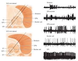 Image result for Pallidotomy
