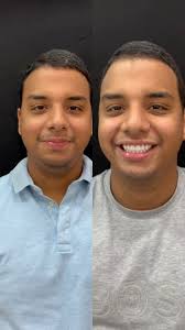 As LENTES EM PORCELANA vão além da estética, elas tem o poder de  transformar O SORRISO e elevar a autoestima., Esse caso foi realmente  transformador, pois o paciente não estava satisfeito com os ...