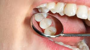 Check spelling or type a new query. Toothaches Is Tooth Sensitivity Months After Filling Normal