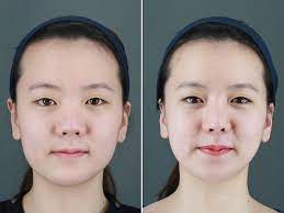 I decided to go to id hospital after my research since they're the only plastic surgery hospital in korea . South Korea S Growing Obsession With Cosmetic Surgery Abc News