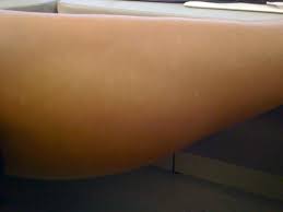 Before starting a laser hair removal treatment, patients seeking the eradication of hair should be. Delayed Hypopigmentation After Laser Hair Removal