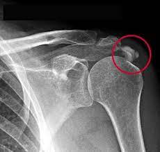 Schulterschmerzen Symptome Verletzung Sehnenruptur Arthrose Oder Entzundung Www Gelenk Doktor De
